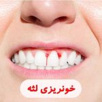 خونریزی لثه