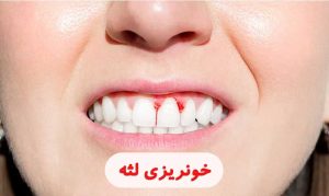 خونریزی لثه