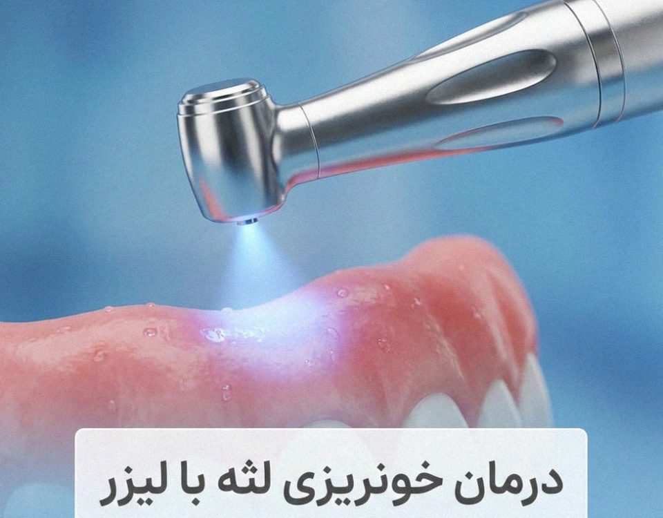 درمان خونریزی لثه با لیزر