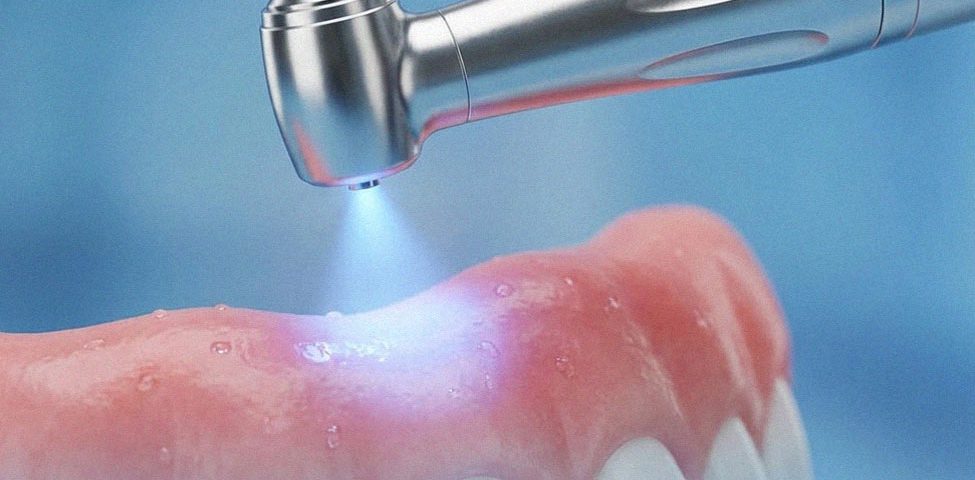 درمان خونریزی لثه با لیزر