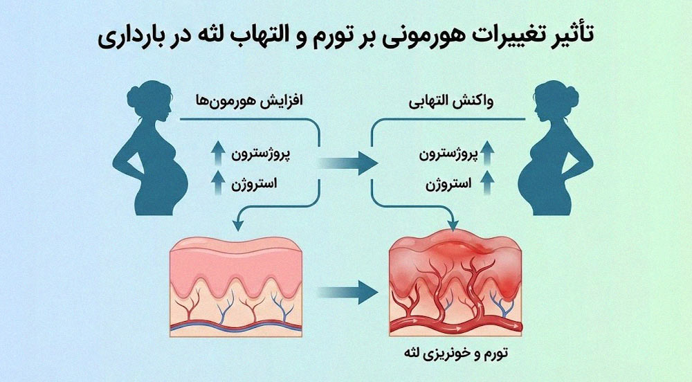 اینفوگرافیک تاثیر هورمون پروژسترون و استروژن بر التهاب و خونریزی لثه در بارداری
