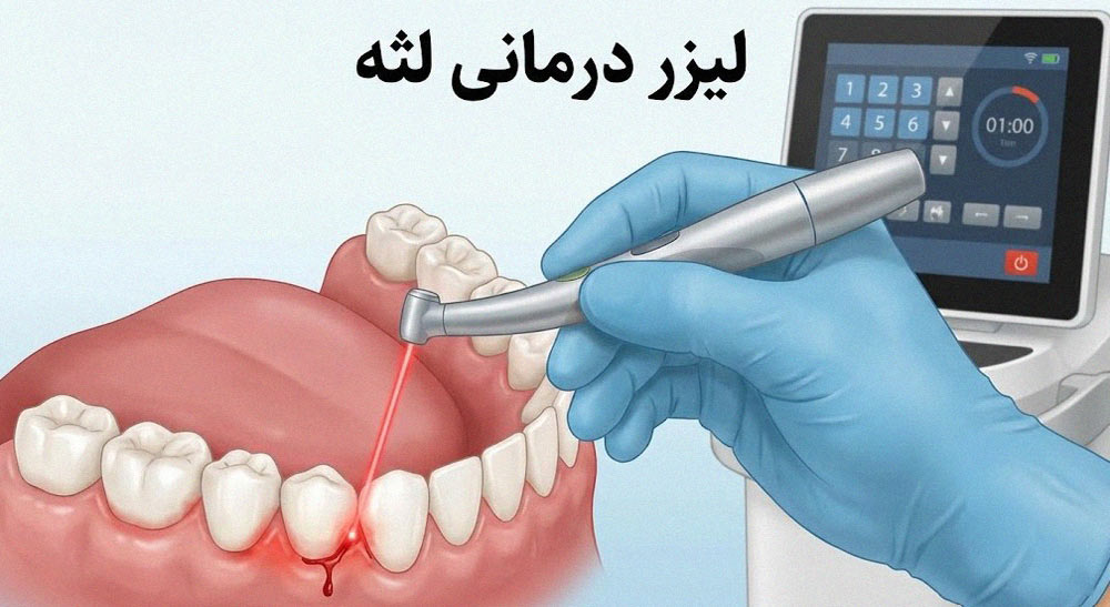 دستگاه لیزر لثه برای درمان کم‌تهاجمی ژنژیویت بارداری بدون بخیه و خونریزی
