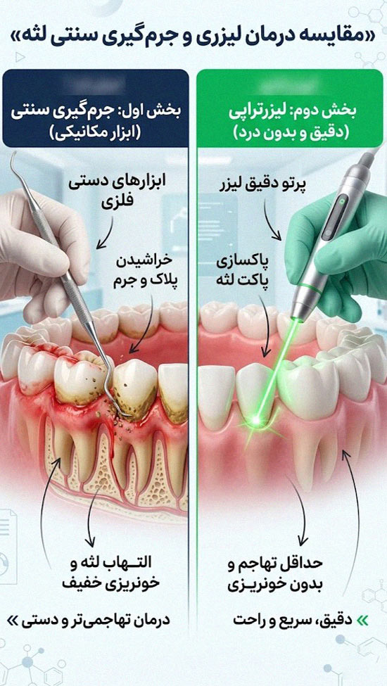 لیزرتراپی لثه و مقایسه آن با روش سنتی جرم گیری