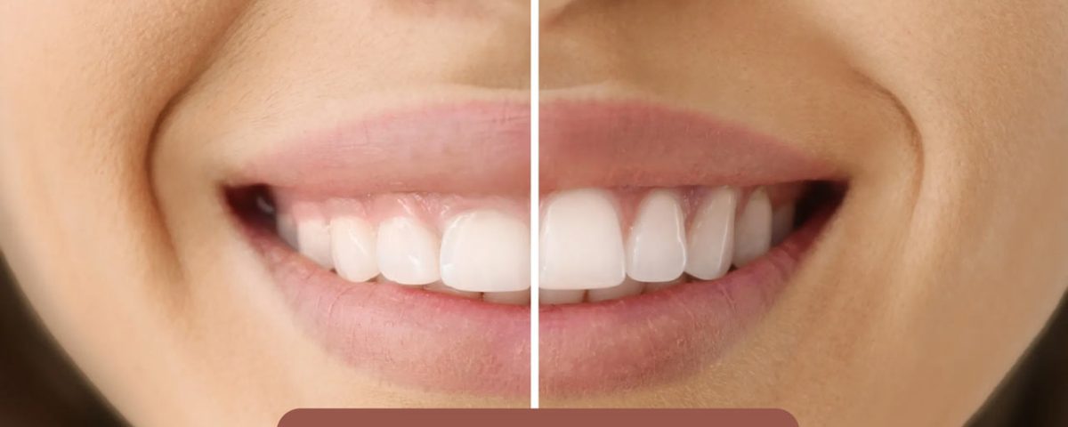 جراحی لثه برای کامپوزیت