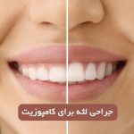 جراحی لثه برای کامپوزیت