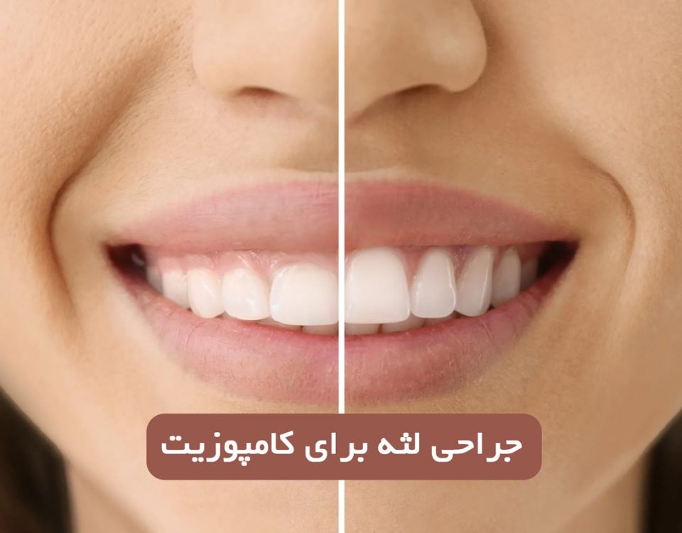 جراحی لثه برای کامپوزیت