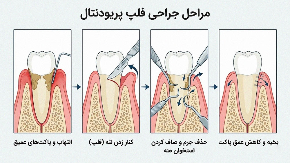 مراحل جراحی فلپ یا پیوند لثه