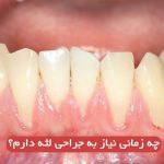 چه زمانی نیاز به جراحی لثه دارم؟