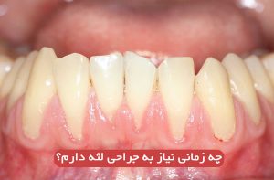 چه زمانی نیاز به جراحی لثه دارم؟