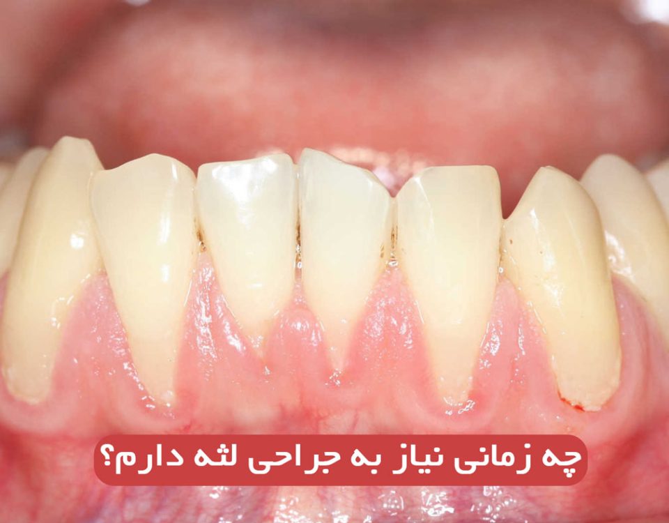 چه زمانی نیاز به جراحی لثه دارم؟