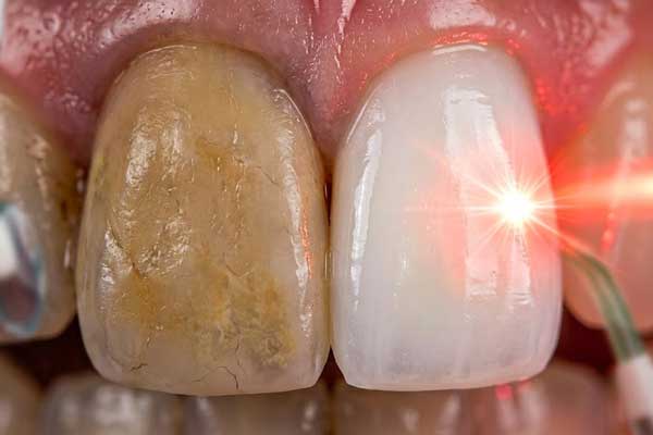 سفید کردن دندانها با دستگاه پیشرفته بلیچینگ لیزری بدون آسیب به مینا