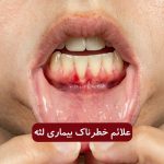 نشانه های خطرناک بیماری لثه که نباید نادیده بگیرید