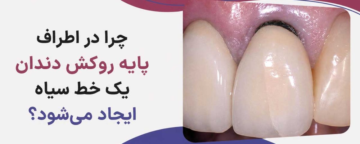 سیاه شدن لثه بعد از روکش دندان