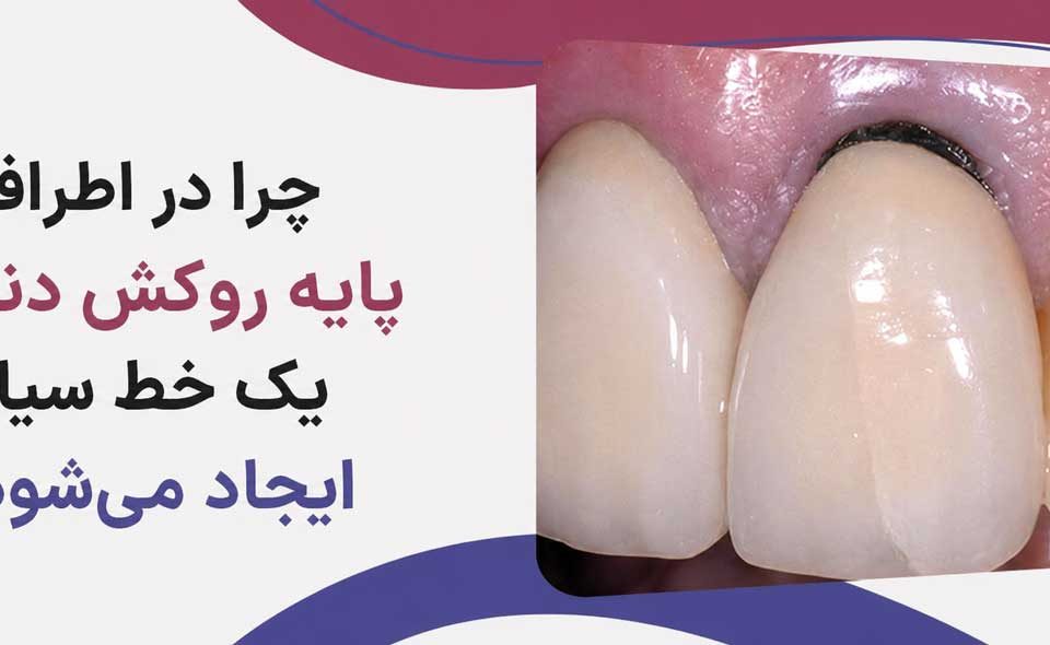سیاه شدن لثه بعد از روکش دندان