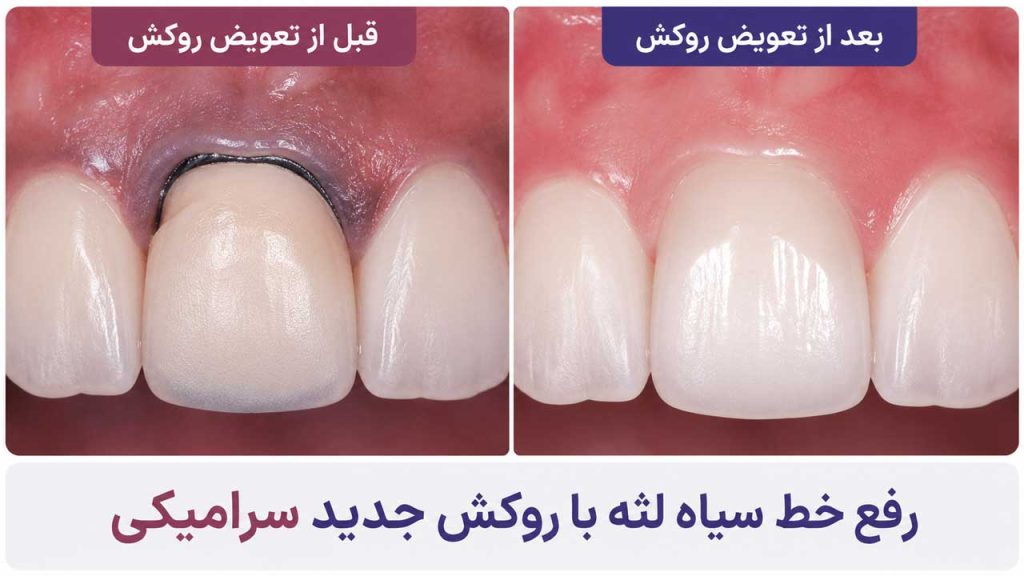 رفع خط سیاه لثه با روکش سرامیکی