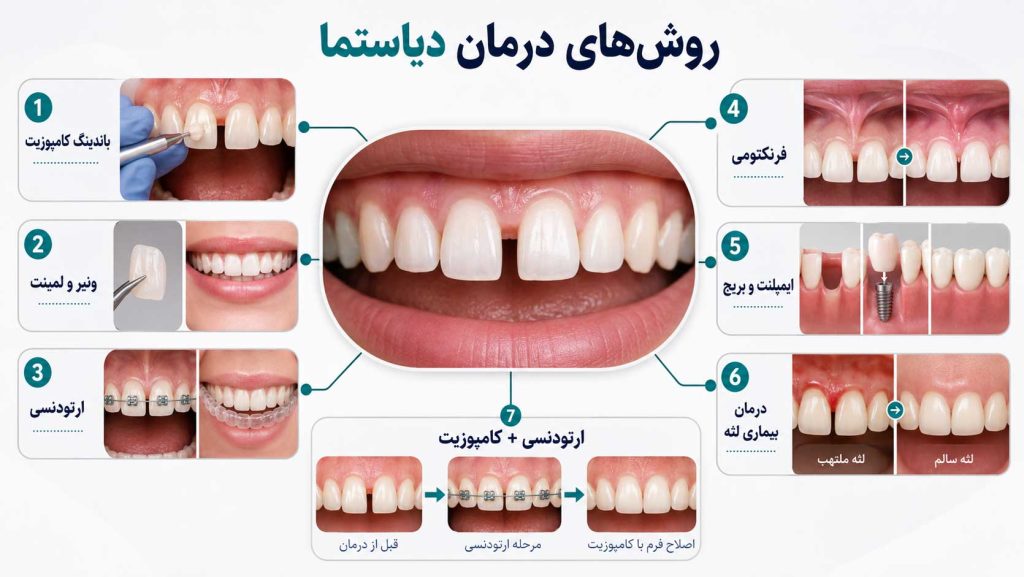 روش‌های درمان فاصله بین دندان‌ها (دیاستما)
