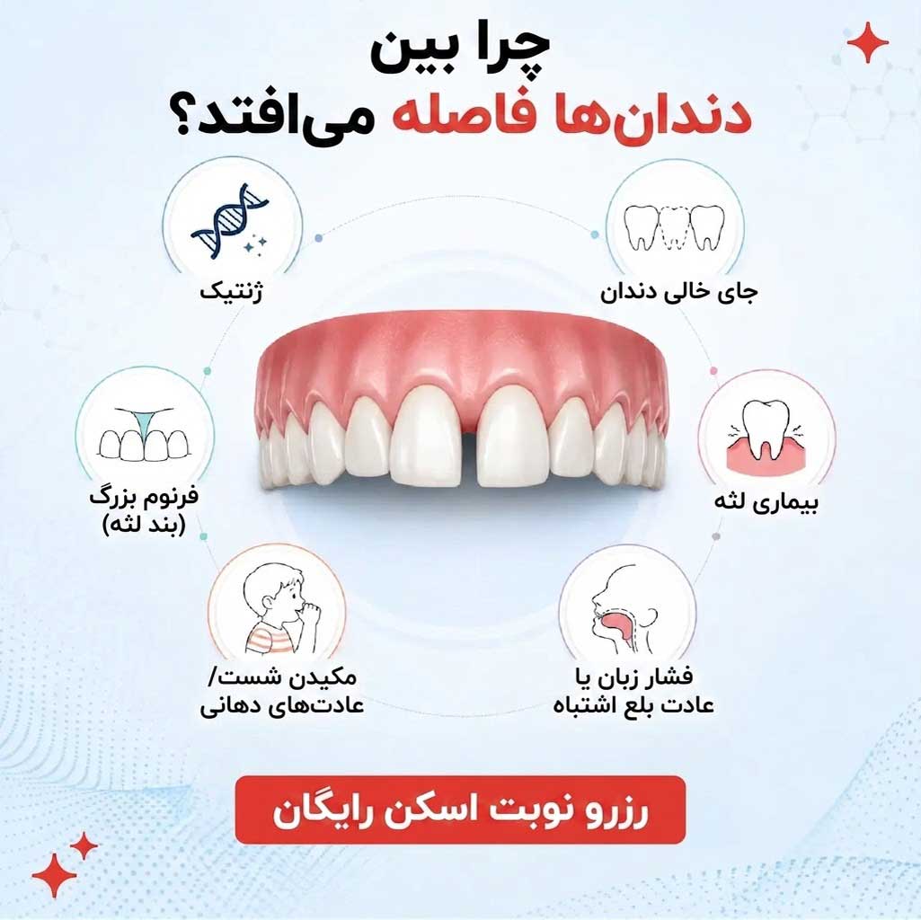 دلایل فاصله بین دندان‌ها (دیاستما)