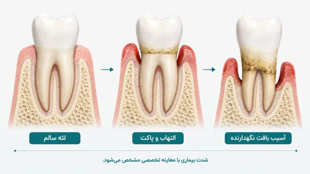 شدت آسیب بافت لثه