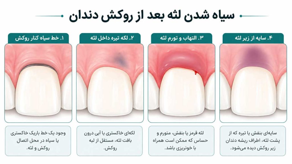 انواع سیاه شدن لثه بعد از روکش دندان