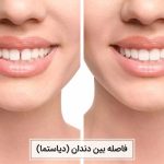 بستن فاصله بین دندان ها (دیاستما)