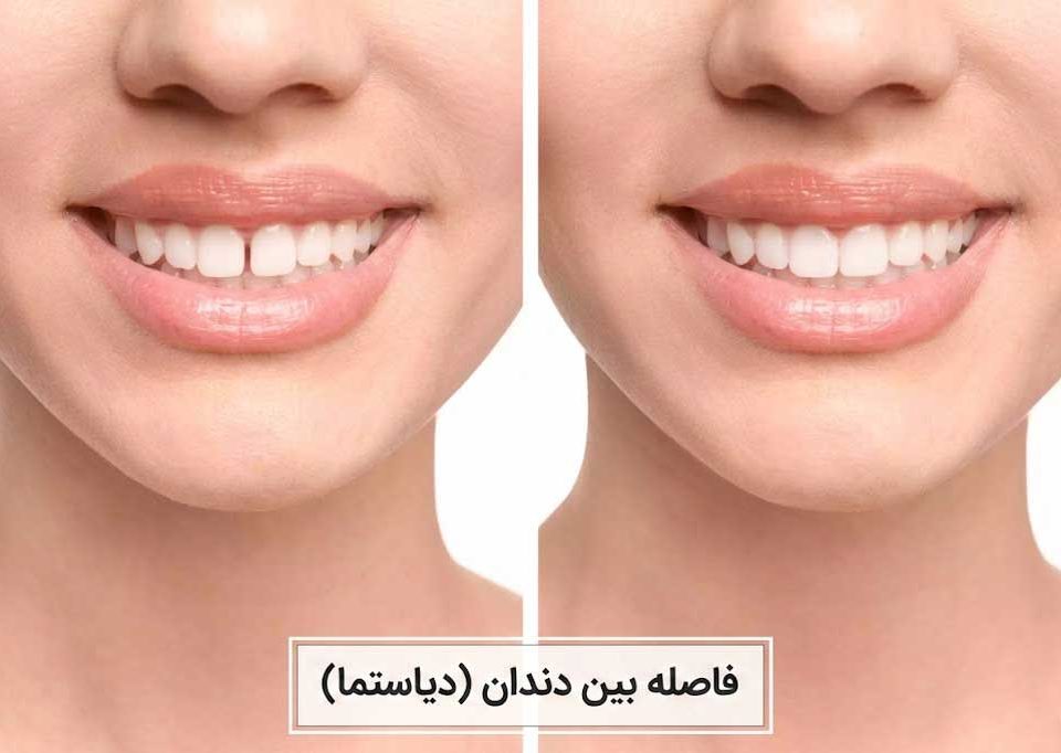 بستن فاصله بین دندان ها (دیاستما)