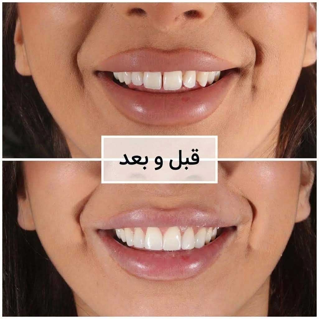 قبل و بعد بستن فاصله بین دندان با کامپوزیت
