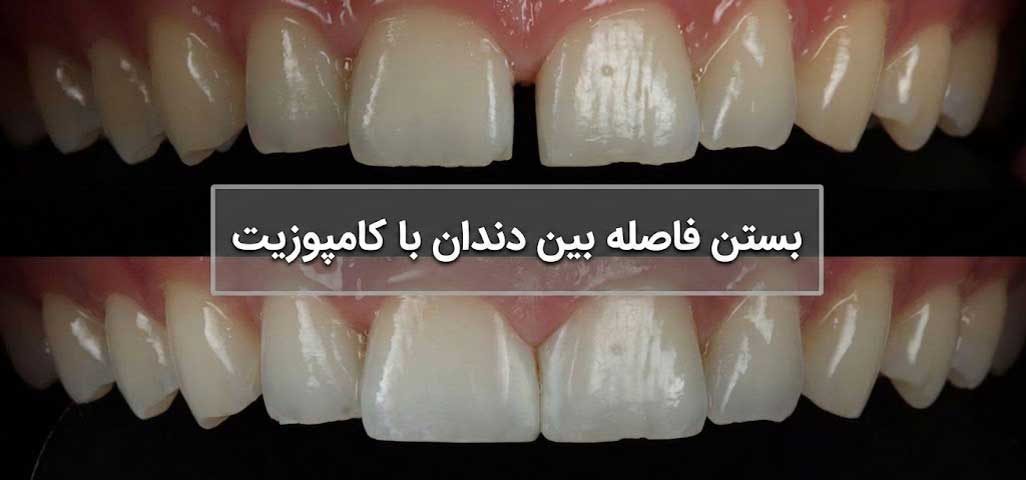 بستن فاصله بین دندان با کامپوزیت