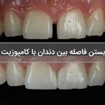بستن فاصله بین دندان با کامپوزیت
