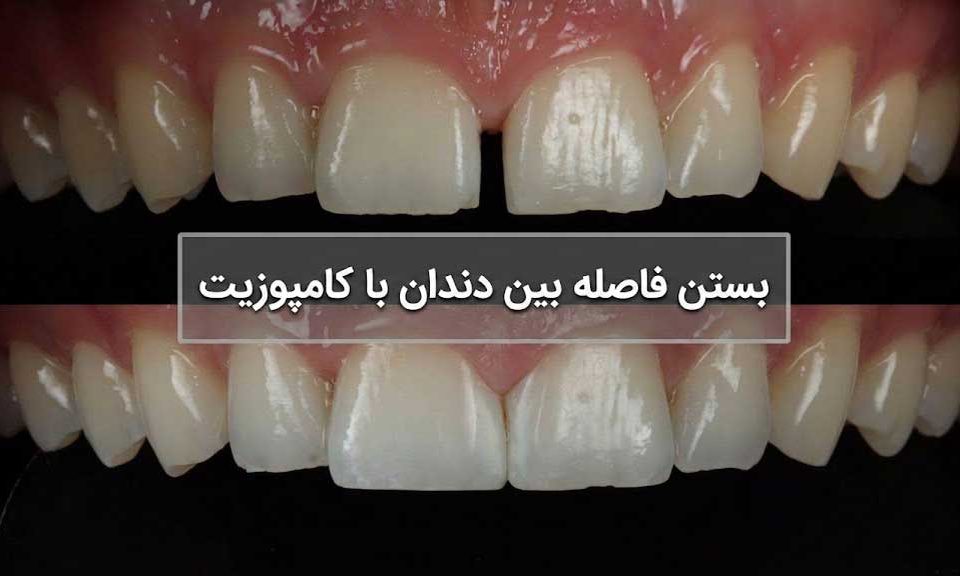 بستن فاصله بین دندان با کامپوزیت