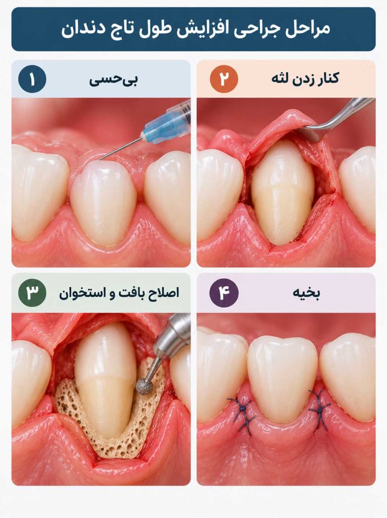 مراحل جراحی افزایش طول تاج دندان
