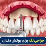 جراحی لثه برای روکش دندان