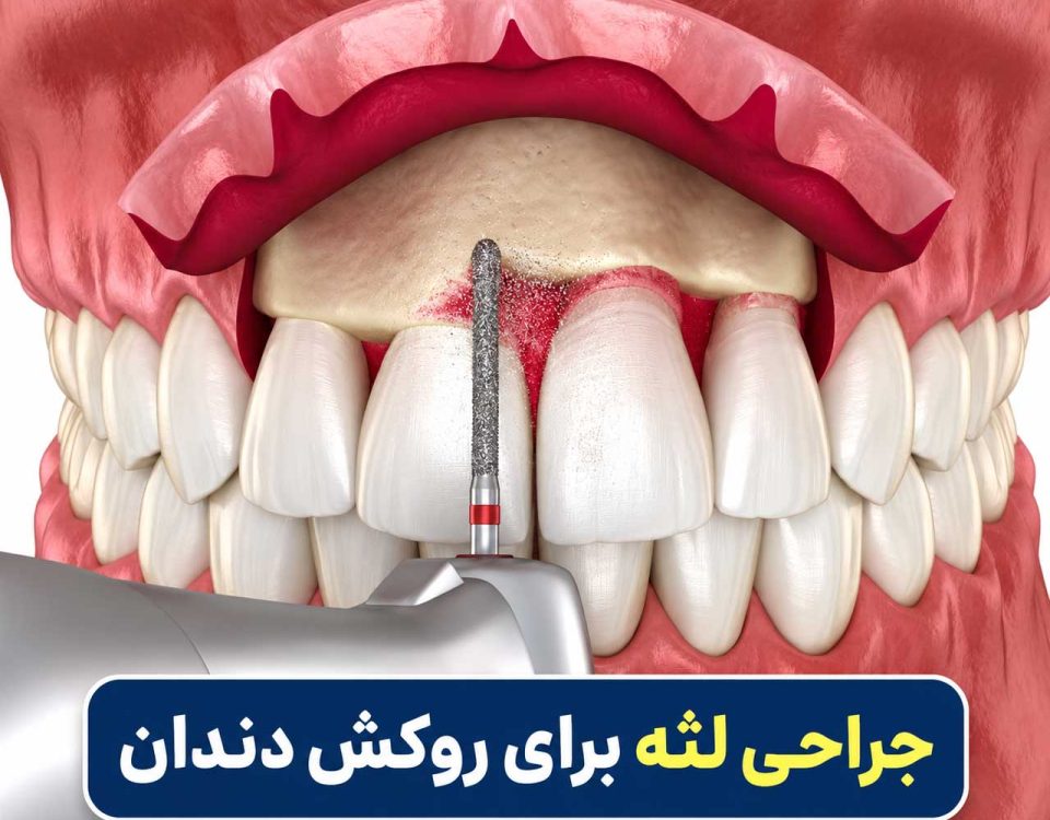جراحی لثه برای روکش دندان