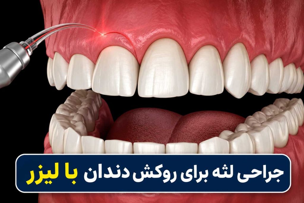 جراحی لثه با لیزر برای آماده سازی دندان جهت روکش