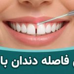 بستن فاصله دندان با لیزر