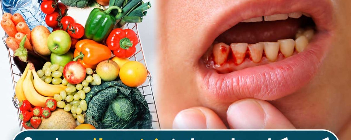 کمبود کدام ویتامین باعث خونریزی لثه میشود؟