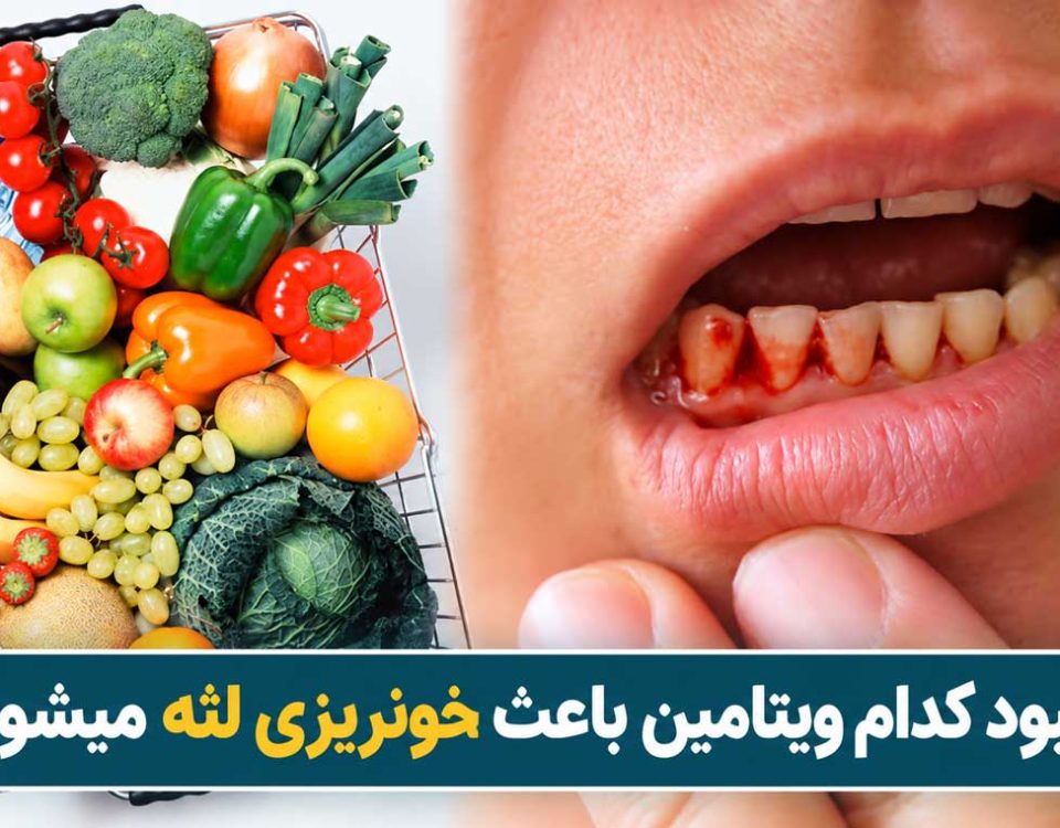 کمبود کدام ویتامین باعث خونریزی لثه میشود؟
