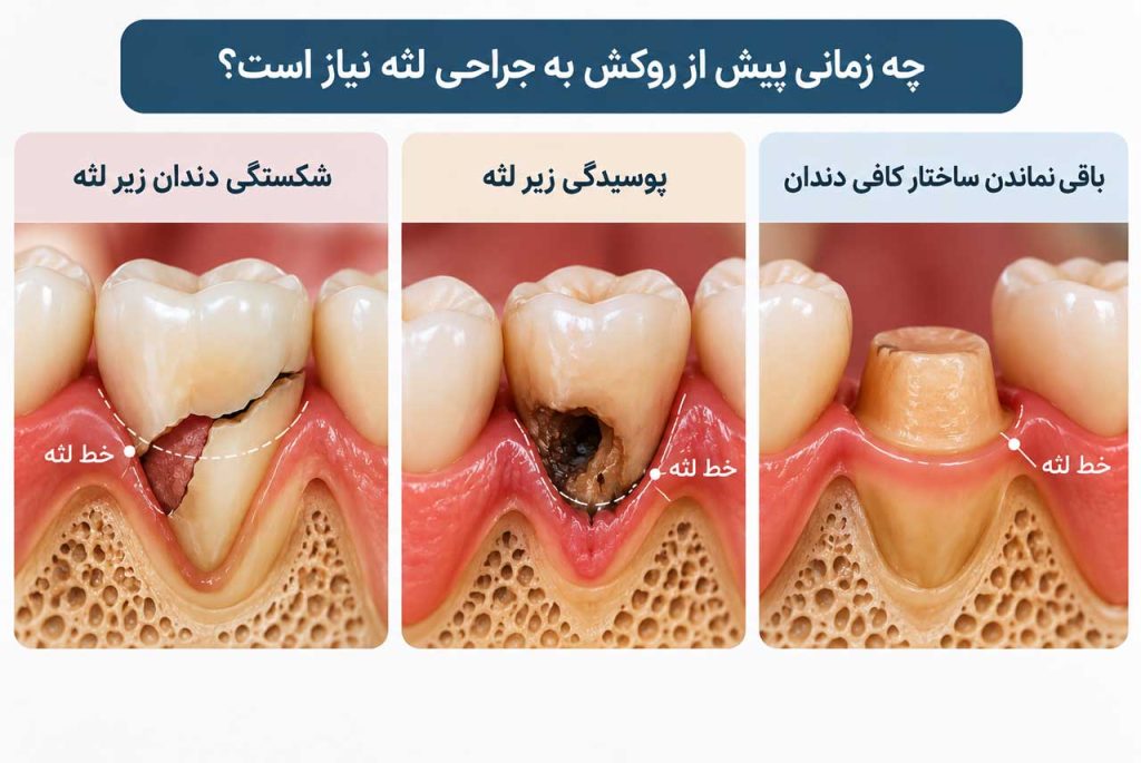 موارد نیاز به جراحی لثه پیش از روکش دندان